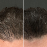 Calecim Advanced Hair System Kit