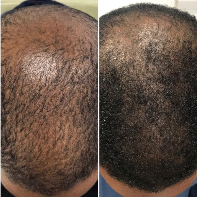 Calecim Advanced Hair System Kit