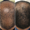 Calecim Advanced Hair System Kit